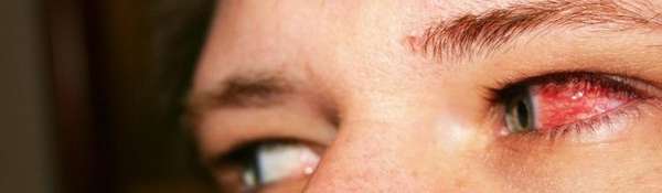 фото красного глаза при конъюнктивите
